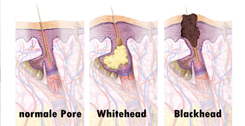 Blackhead-Whitehead-Unterschied